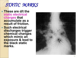 STATIC MARKS
 These are d/t the
static electrical
charges that
accumulate as a
result of friction.
 Such electrical
discharges trigger
chemical changes
which mimic an
exposure & lead to
the black static
marks.
78
 