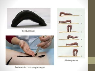 Sanguessuga
Mede-palmos
Tratamento com sanguessugas
 