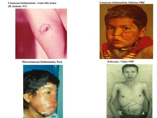 Cutaneous leishmaniasis –crater-like lesion   (H. Zaiman, NY) Cutaneous leishmaniasis, Pakistan 1980’ Kala-azar,  China 1950’ 