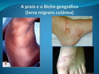 A praia e o Bicho-geográfico
(larva migrans cutânea)
 