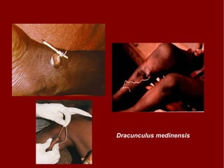 Dracunculus medinensis 