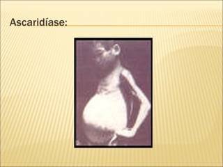 Ascaridíase:
 