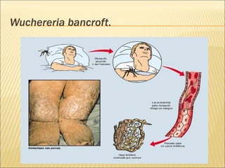 Wuchereria bancroft.
 