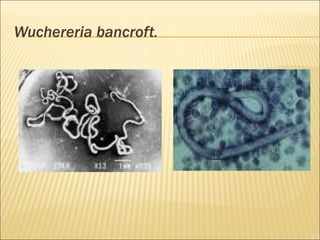 Wuchereria bancroft.
 