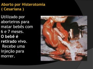Aborto por Histerotomia
( Cesariana )

Utilizado por
aborteiros para
matar bebês com
6 e 7 meses.
O bebê é
retirado vivo.
 Recebe uma
injeção para
morrer.
 