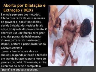 Aborto por Dilatação e
 Extração ( D&X)
É o mais perverso dos métodos.
É feito com cerca de vinte semanas
de gravidez e, não é tão simples,
devido à rigidez dos tecidos fetais
nesse estágio de desenvolvimento. O
abortista usa um fórceps para girar
uma das pernas do bebê e puxar
através do canal de nascimento.
Depois, perfura a parte posterior da
cabeça com uma
 tesoura bem afiada e abre as
lâminas, rasgando o tecido e fazendo
um grande buraco na parte mole do
pescoço do bebê. Finalmente, aspira
o cérebro do bebê e completa o
“parto” em poucos segundos.
 