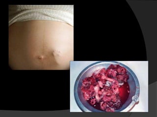  aborto