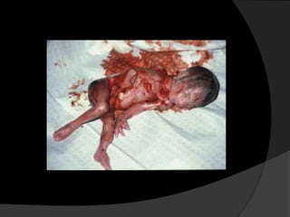  aborto