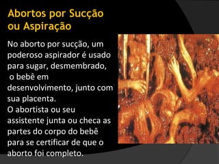 Abortos por Sucção
ou Aspiração
No aborto por sucção, um
poderoso aspirador é usado
para sugar, desmembrado,
 o bebê em
desenvolvimento, junto com
sua placenta.
O abortista ou seu
assistente junta ou checa as
partes do corpo do bebê
para se certificar de que o
aborto foi completo.
 