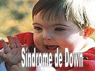 Síndrome de Down 