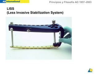 Principios y Filosofía AO 1957–2003
LISS
(Less Invasive Stabilization System)
 