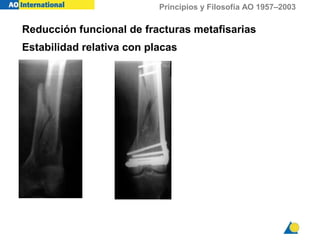 Principios y Filosofía AO 1957–2003
Reducción funcional de fracturas metafisarias
Estabilidad relativa con placas
 