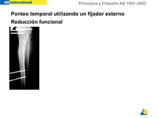 Principios y Filosofía AO 1957–2003
Ponteo temporal utilizando un fijador externo
Reducción funcional
 