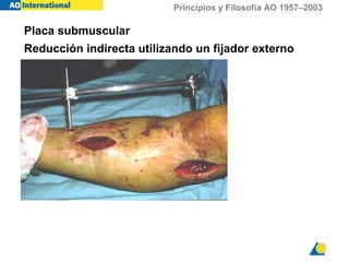Principios y Filosofía AO 1957–2003
Placa submuscular
Reducción indirecta utilizando un fijador externo
 
