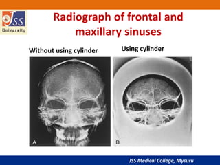 JSS Medical College, Mysuru
Radiograph of frontal and
maxillary sinuses
Without using cylinder Using cylinder
 