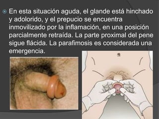    En esta situación aguda, el glande está hinchado
    y adolorido, y el prepucio se encuentra
    inmovilizado por la inflamación, en una posición
    parcialmente retraída. La parte proximal del pene
    sigue flácida. La parafimosis es considerada una
    emergencia.
 