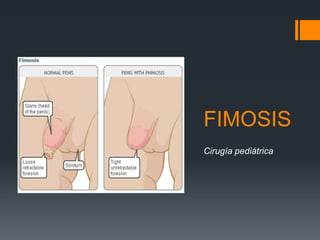 FIMOSIS
Cirugía pediátrica
 
