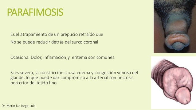Fimosis y parafimosis