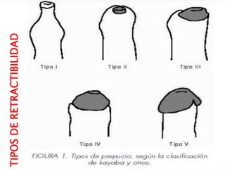 TIPOSDERETRACTIBILIDAD
 