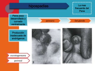 hipospadias
Pene poco
desarrollado y
curvado
ventralmente
Producción
inadecuada de
andrógenos

escrotogeneano
perineal

peneano

La mas
frecuente del
Pene

Del glande

 