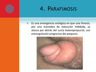 4. PARAFIMOSIS


Es una emergencia urológica en que una fimosis,
por una maniobra de reducción indebida, se
atasca por detrás del surco balanoprepucial, con
estrangulación progresiva del prepucio.

 