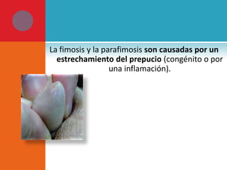 La fimosis y la parafimosis son causadas por un
estrechamiento del prepucio (congénito o por
una inflamación).

 