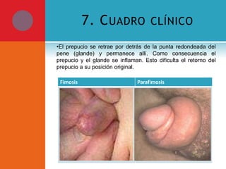 7. C UADRO

CLÍNICO

•El prepucio se retrae por detrás de la punta redondeada del
pene (glande) y permanece allí. Como consecuencia el
prepucio y el glande se inflaman. Esto dificulta el retorno del
prepucio a su posición original.
Fimosis

Parafimosis

•Abultamiento del prepucio
durante la micción.

•Tumefacción de la punta del
pene al retraer el prepucio o
llevarlo hacia atrás.
•Dolor.
•Incapacidad para llevar el
prepucio hacia atrás y colocarlo
sobre la punta del pene.
•Decoloración de la punta del
pene, la cual muestra un color
rojo oscuro o azulado.

•Incapacidad
para
retraer
completamente el prepucio a
los 3 años de edad (en algunos
niños, este proceso puede
demorar más tiempo).

 