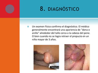 8.


DIAGNÓSTICO

Un examen físico confirma el diagnóstico. El médico
generalmente encontrará una apariencia de "dona o
anillo" alrededor del tallo cerca a la cabeza del pene.
O bien cuando no se logra retraer el prepucio en un
niño mayor de 3 años.

 