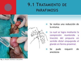 9.1 T RATAMIENTO DE
PARAFIMOSIS



Se realiza una reducción de
la misma.



La cual se logra mediante la
compresión mantenida y
tracción del prepucio en
sentido distal empujando el
glande en forma proximal.



Se pude
anestesia

requerir

de

 