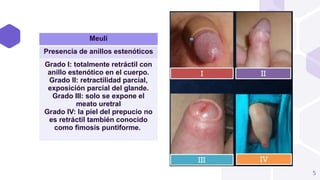 fimosis-y-parafimosis-cirugia-pediatrica-pptx