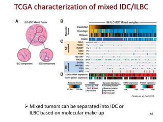 Idca Cancer Invasive Lobular Carcinoma — Highlights from the First Ever ILC ...