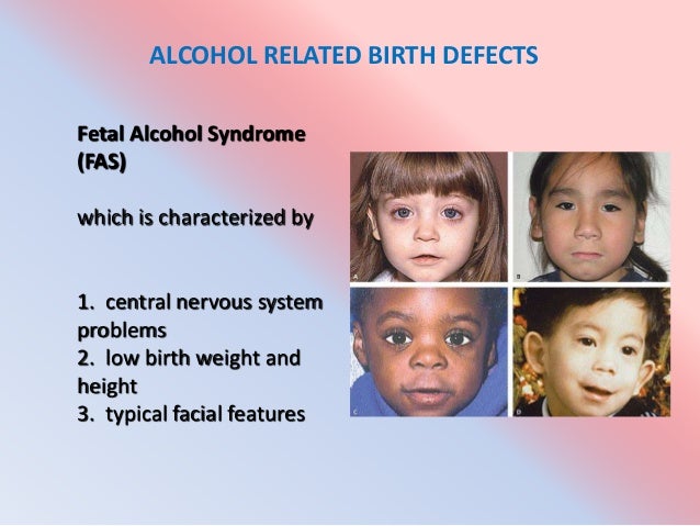 alcohol related birth defects in the 1990s Their daughter akila lives with a fetal alcohol spectrum disorder (fasd) disorder (arnd) and alcohol-related birth defects (arbd) organization on fetal alcohol syndrome (nofas), which was founded in 1990. alcohol related birth defects in the 1990s Their daughter akila lives with a fetal alcohol spectrum disorder (fasd) disorder (arnd) and alcohol-related birth defects (arbd) organization on fetal alcohol syndrome (nofas), which was founded in 1990.