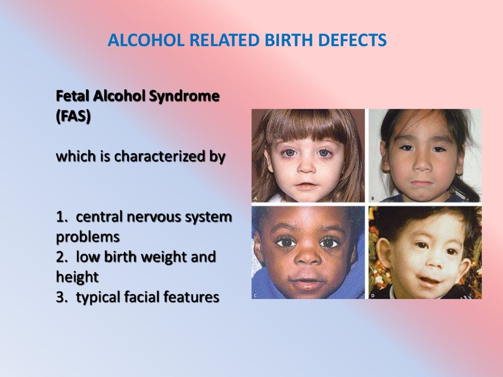 Fetal Alcohol Syndrome