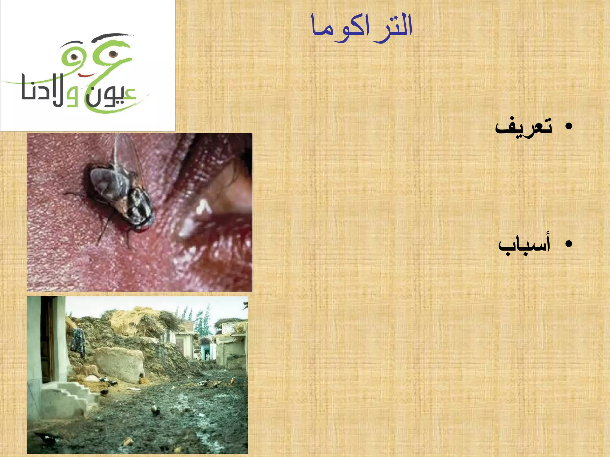 التراكوما تعريف أسباب 