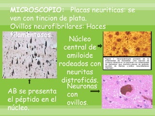 MICROSCOPIO: Placas neuriticas: se ven con tincion de plata.Ovillos neurofibrilares: Haces filamentosos.Núcleo central de amiloide rodeados con neuritas distroficás.Neuronas con ovillos. AB se presenta el péptido en el núcleo.