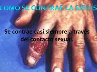 Se contrae casi siempre a través
      del contacto sexual.
 