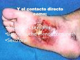 Y el contacto directo
            como;


•Relaciones sexuales
•Besos(mucho menos comunes)
•Sexo oral
 