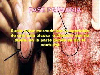 Suele estar marcada por la aparición
de una sola úlcera o chancro que no
 duele, en la parte donde se dio el
              contacto
 