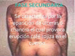 Se caracteriza por la
  aparición de ulceras o
 chancro el cual provoca
erupción café rojiza en el
         cuerpo.
 