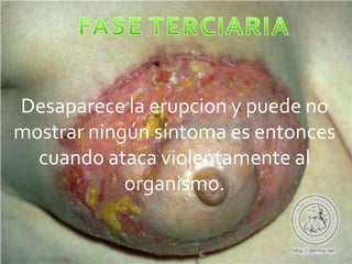 Desaparece la erupcion y puede no
mostrar ningún síntoma es entonces
  cuando ataca violentamente al
            organismo.
 