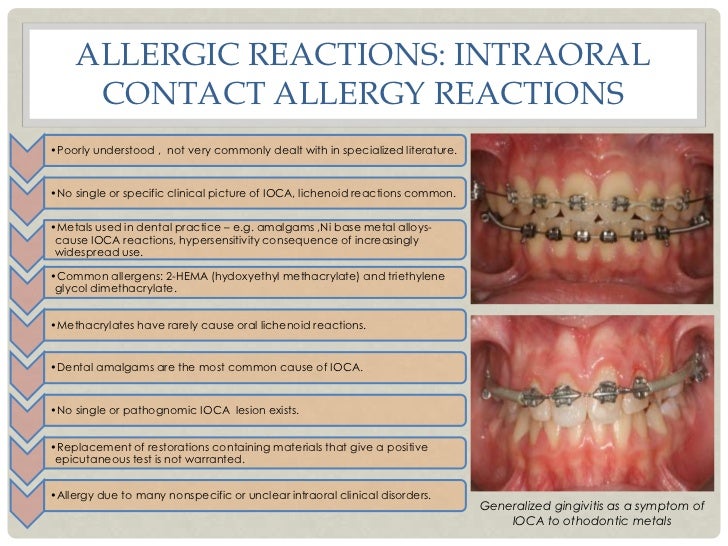 Mucosal Response To Oral Prostheses