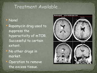 None! Rapamycin drug used to suppress the hyperactivity of mTOR. Successful to certain extent. No other drugs in market. Operation to remove the excess tissue. 