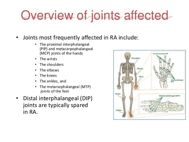 rheumatoid-arthritis-early-diagnosis-and-treatment