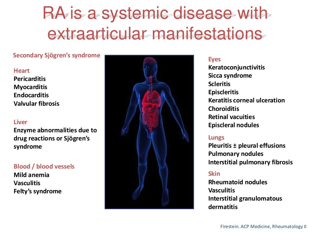 Rheumatoid Arthritis Early Diagnosis and Treatment