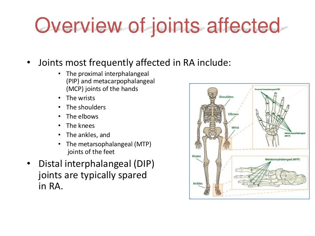 Rheumatoid Arthritis Early Diagnosis and Treatment