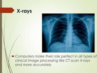 X-rays
Computers make their role perfect in all types of
clinical image processing like CT scan X-rays
and more accurately
 