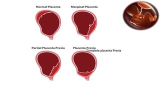 Complete placenta Previa 
 