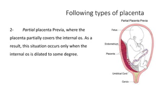 Following types of placenta 
2- Partial placenta Previa, where the 
placenta partially covers the internal os. As a 
result, this situation occurs only when the 
internal os is dilated to some degree. 
 