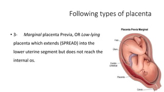 Following types of placenta 
• 3- Marginal placenta Previa, OR Low-lying 
placenta which extends (SPREAD) into the 
lower uterine segment but does not reach the 
internal os. 
 
