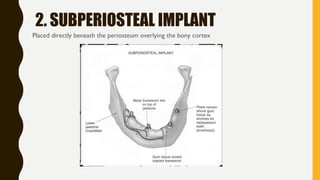 2. SUBPERIOSTEAL IMPLANT
Placed directly beneath the periosteum overlying the bony cortex
 